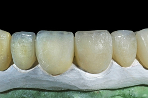 dental Porcelain