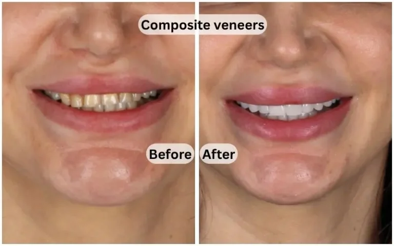 Composite-veneers-brefor-after.webp