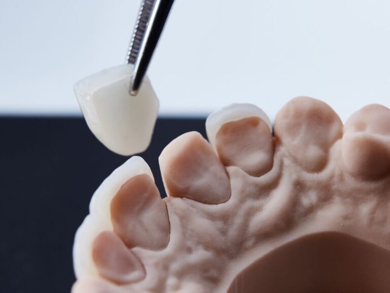 Dental-Veneers-in-Turkey-Graphic-View