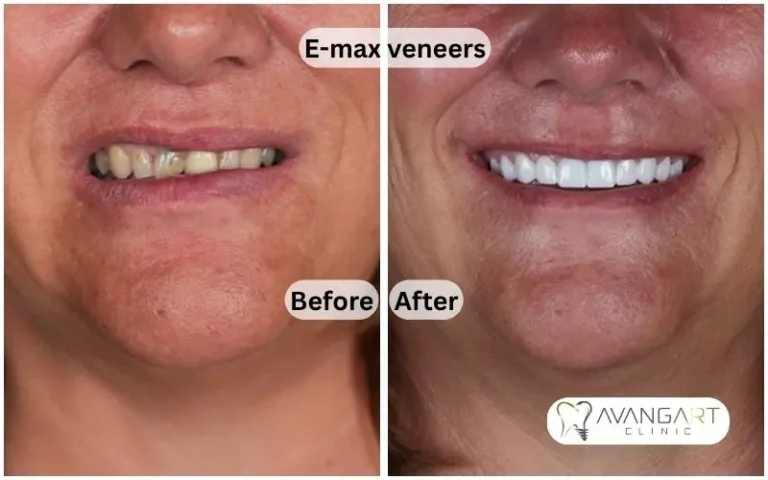 E-max-veneers-brefor-after.webp