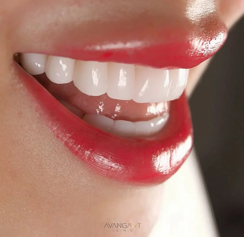 Hollywood Smile A_AFTER dental-veneers-in-turkey-after-anila