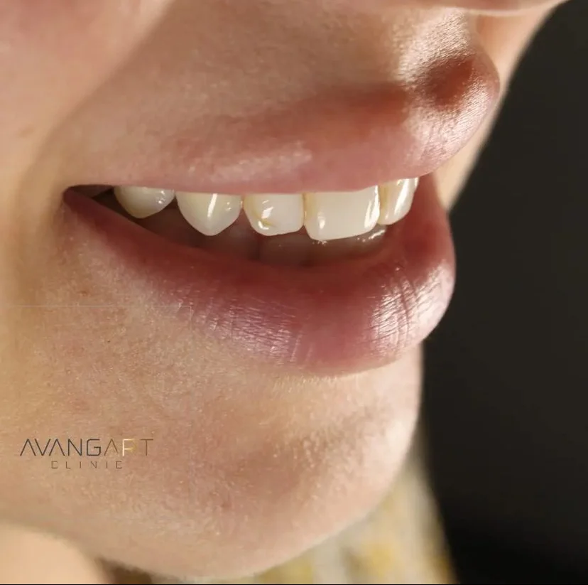 Hollywood Smile A_BEFORE Hollywood Smile A_BEFORE