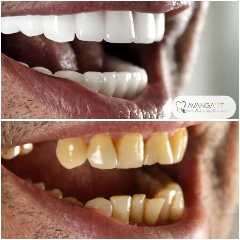 Hollywood-Smile-Makeover.jpg
