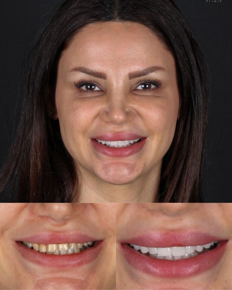 Who-is-the-Right-Candidate-for-Veneers-in-Turkey