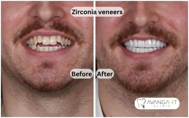 Zirconia-veneers-brefor-after.webp