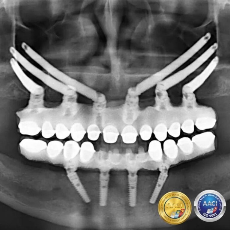 Zygomatic-Implants-in-Turkey