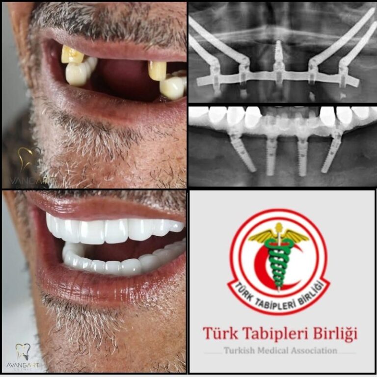 Zygomatic-dental-Implant-surgery-in-Turkey.jpg