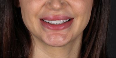 dental-veneer-in-turkey-final-look