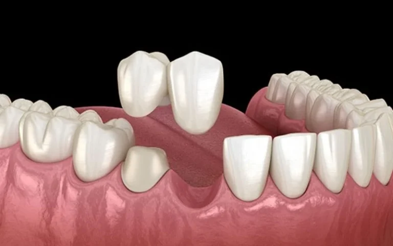 Cantilever-dental-bridge.webp