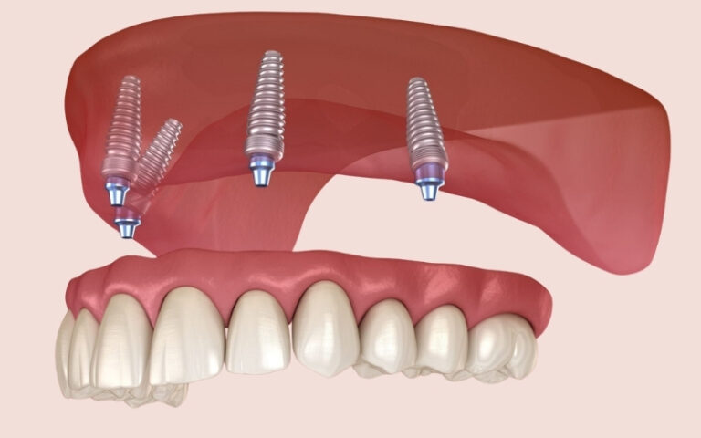 How many implants are needed for an upper denture