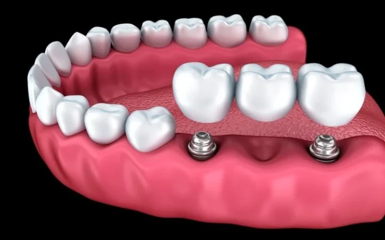 Implant-supported-dental-bridge.webp