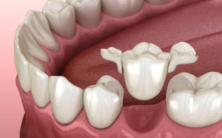 Maryland-dental-bridge.webp