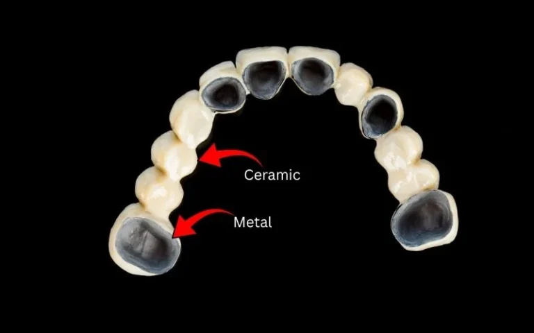 Metal-Ceramic-Bridges.webp