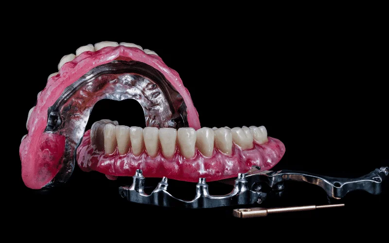 All-on-4 vs. All-on-6 vs. All-on-8: A Clinical Guide to Full-Arch Dental Implants