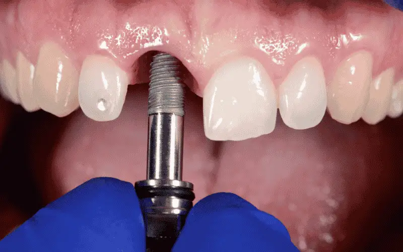 Implant