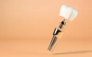 How to Claim German Health Insurance Subsidies for Dental Implants in Turkey: GKV & PKV Guide