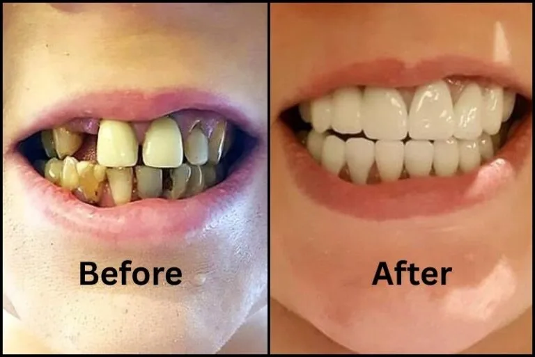 how-do-you-fix-rotten-teeth-1