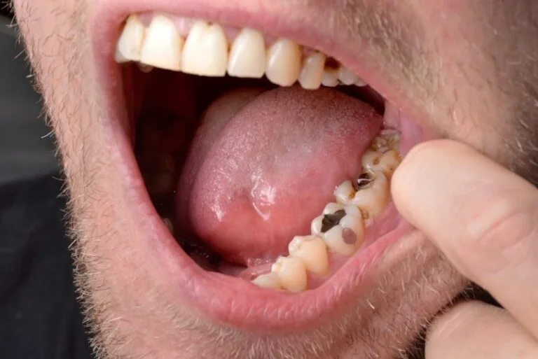 how-do-you-fix-rotten-teeth