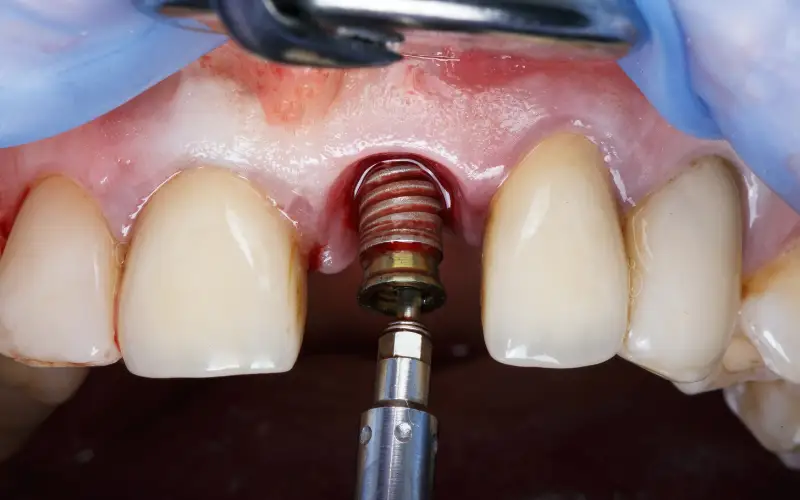 late-implant-placement-procedure