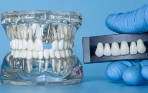 Can a Dental Implant Fall Out? Identifying Early and Late Implant Failures