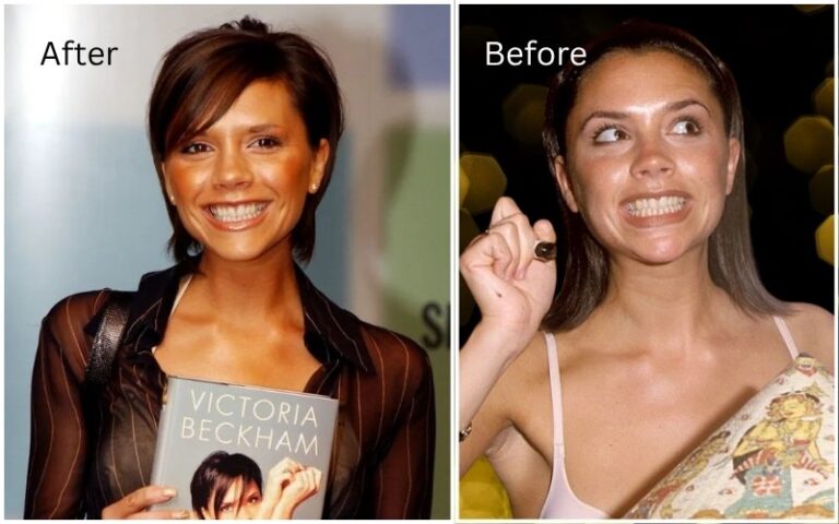 Beckham-before-after