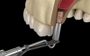 Sinus Lift Surgery in Turkey: When Do You Need It for Dental Implants?