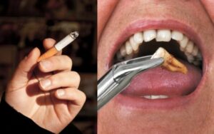 Smoking After Tooth Extraction: When Is It Actually Safe?