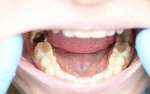 Turkey Teeth Gone Wrong (2026): Legal Rights, Warning Signs & Cost to Fix Failed Dental Work