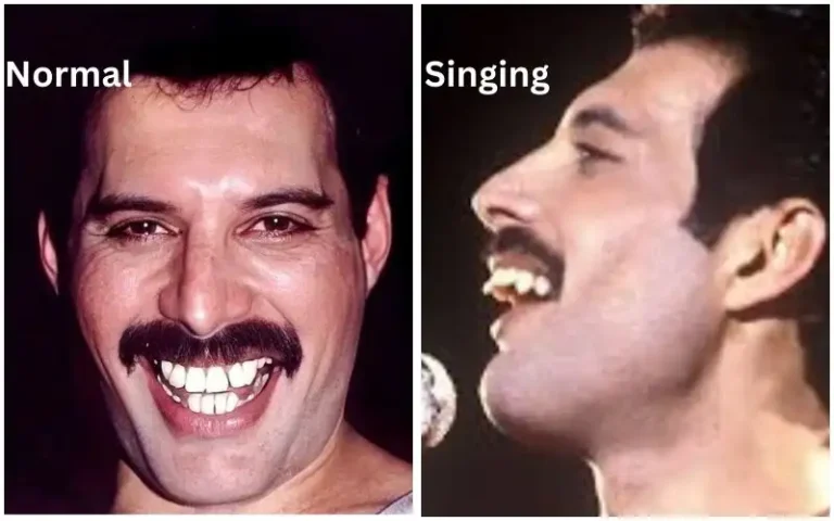 Freddie-Mercury-teeth-condition