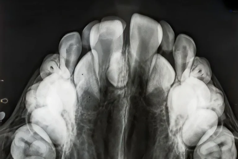 Hyperdontia
