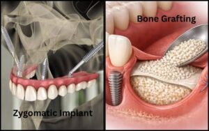 Zygomatic Implants vs. Bone Grafting: Solutions for Severe Upper Jawbone Loss